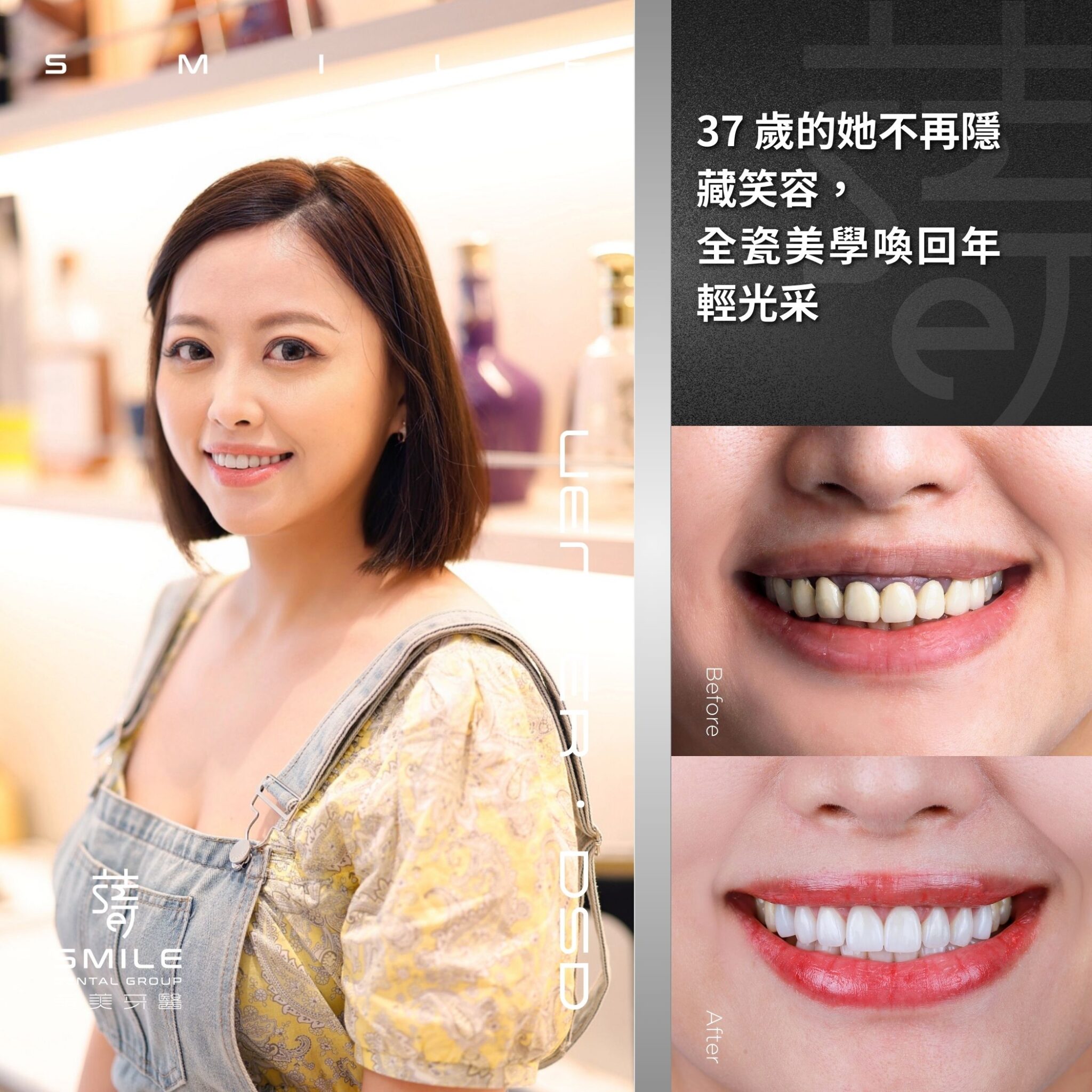 37 歲的她不再隱藏笑容， 全瓷美學喚回年輕光采