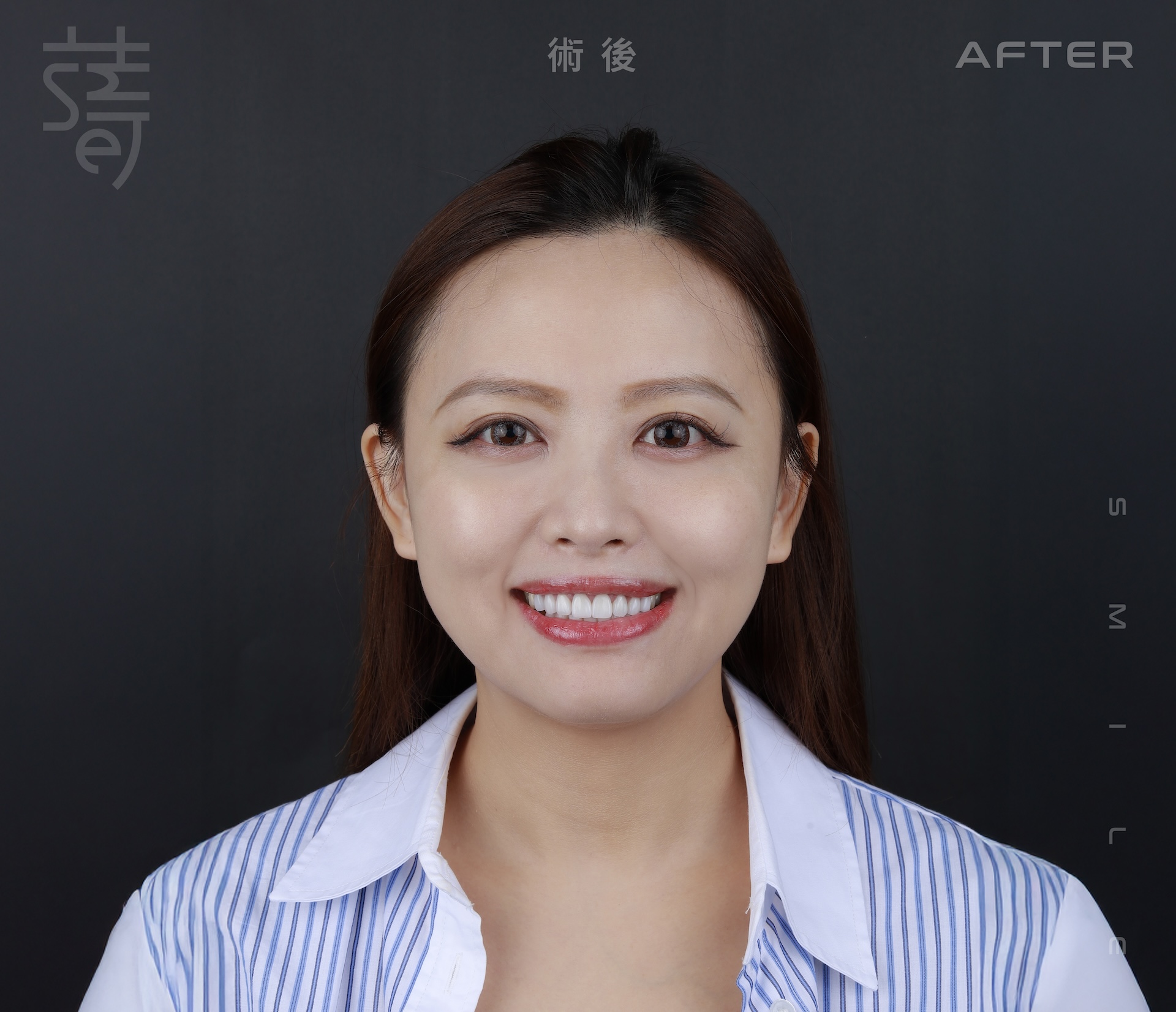 BA正面 術後