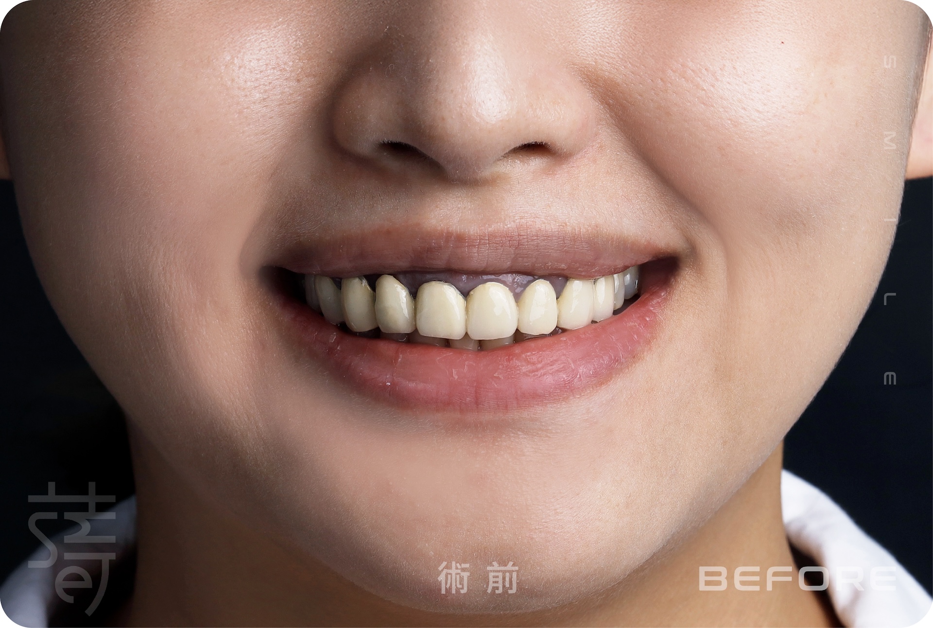 BA 下顏部