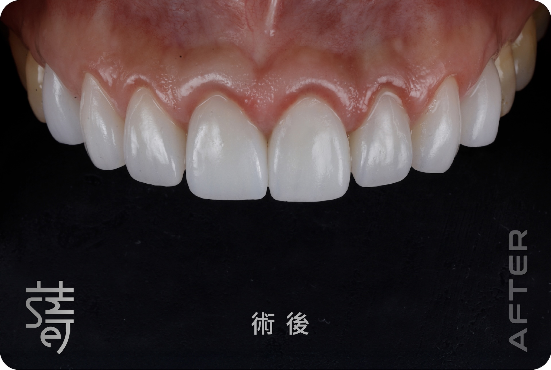 BA 下顏部