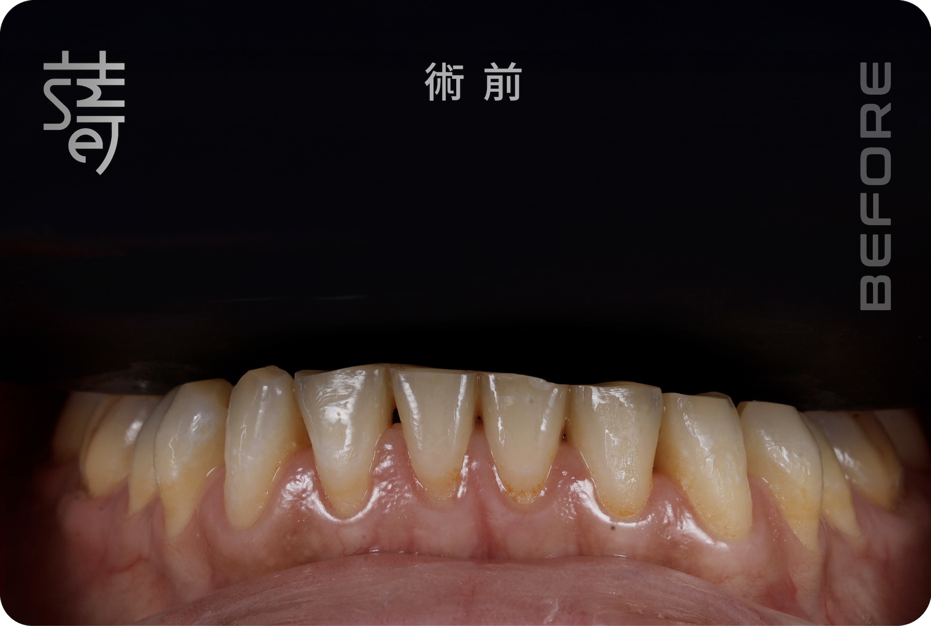 BA 下顏部