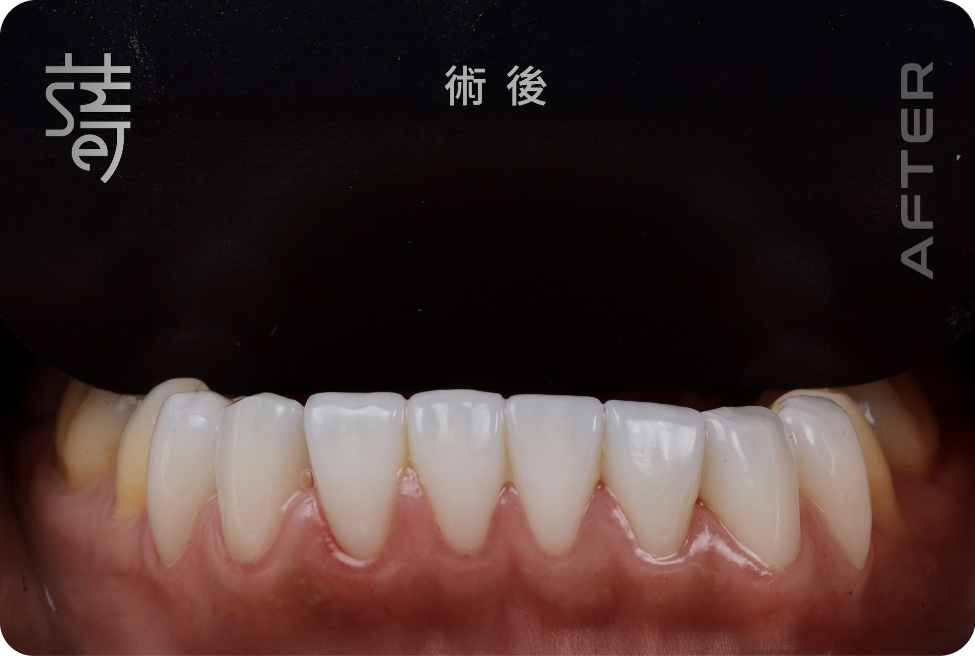 BA 下顏部