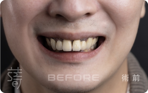 BEFORE全口咬合重建