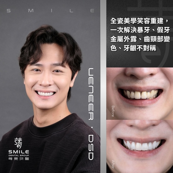 官網案例封面 - 35歲上班族，靠全瓷美學笑容重建一次解決暴牙、假牙金屬外露、齒頸部變色、牙齦不對稱