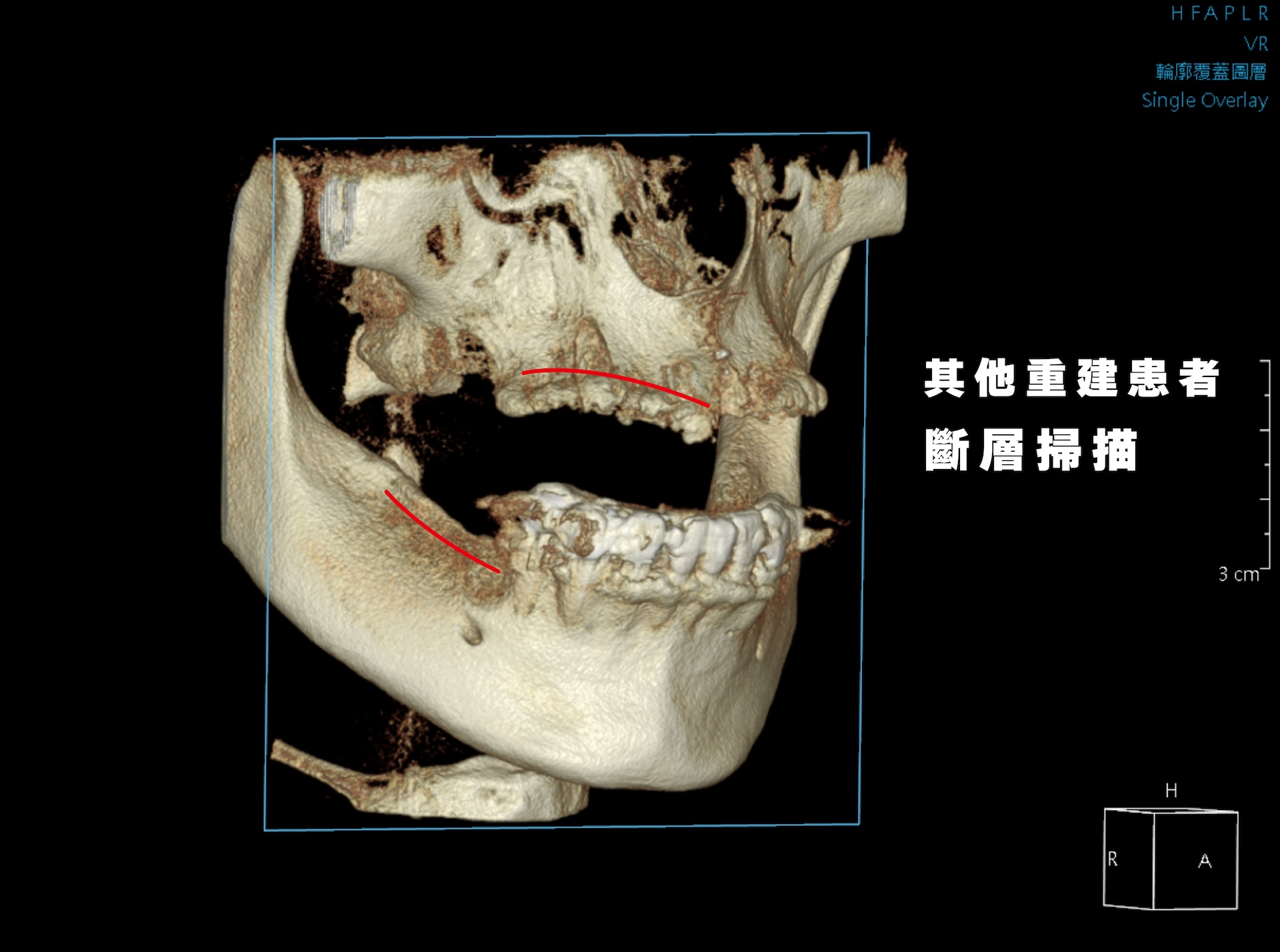 其他重建患者CT