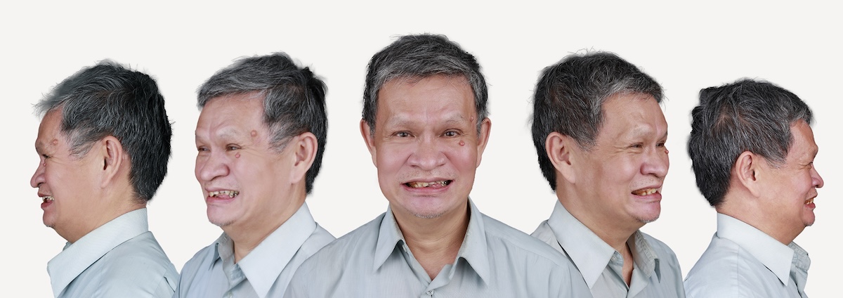 術前莫五面圖-2-拷貝