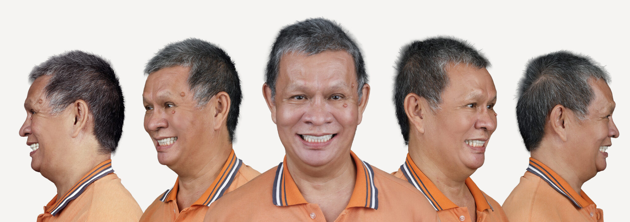 術後 莫益南五面圖