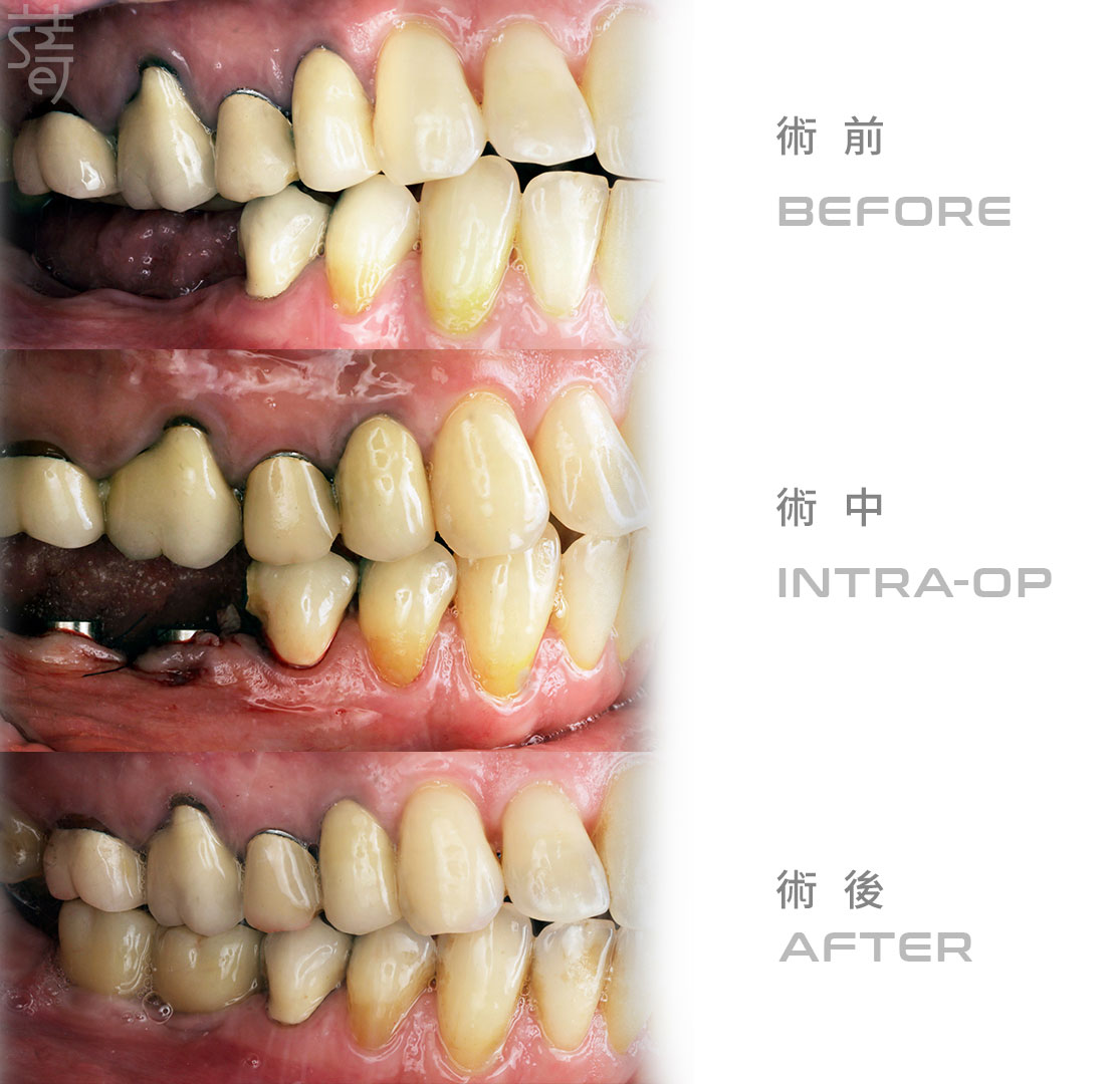 跨越語言與距離,專利水植體植牙,陪伴捷克教師重拾笑容-白色版-ba-拷貝