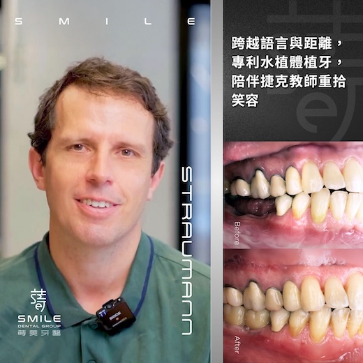 官網案例封面 - 跨越語言與距離,專利水植體植牙,陪伴捷克教師重拾笑容