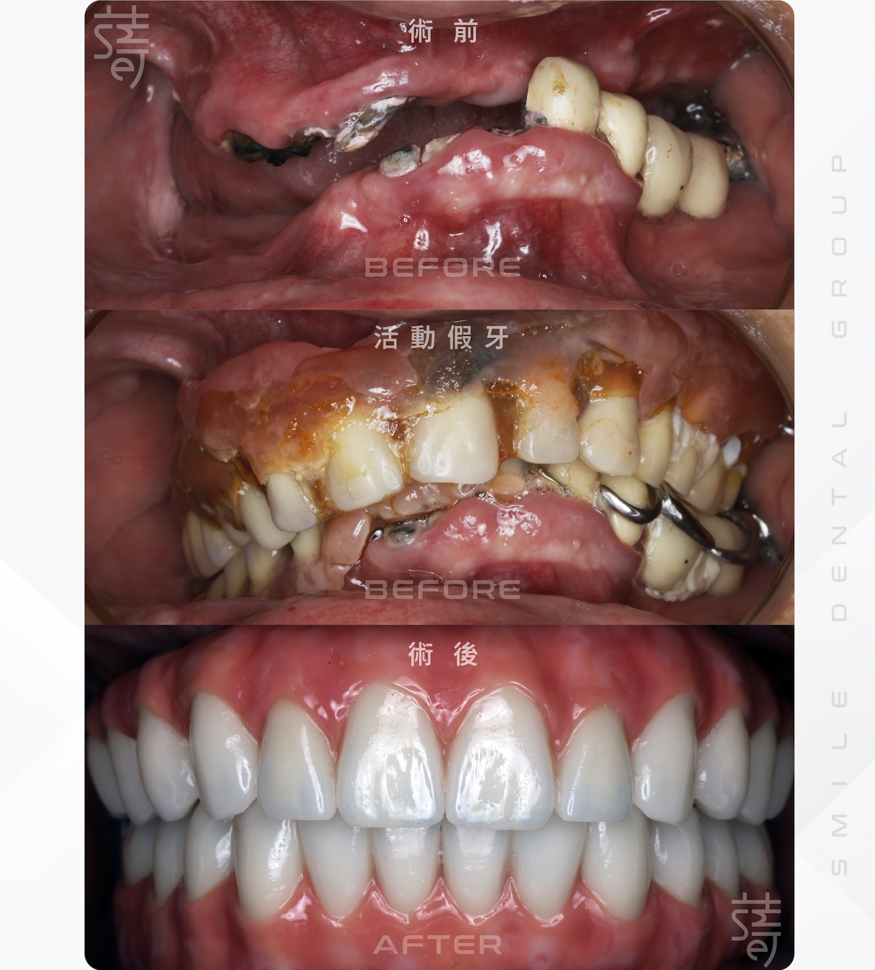 3 全口咬合重建