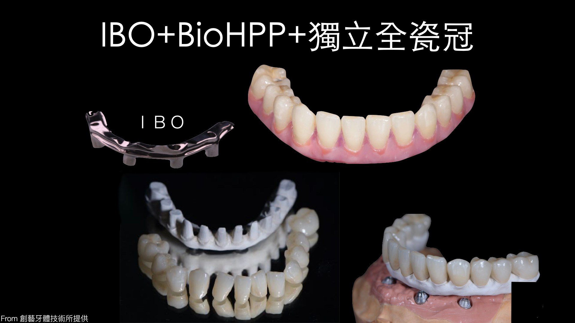 AO4_獨立假牙_M