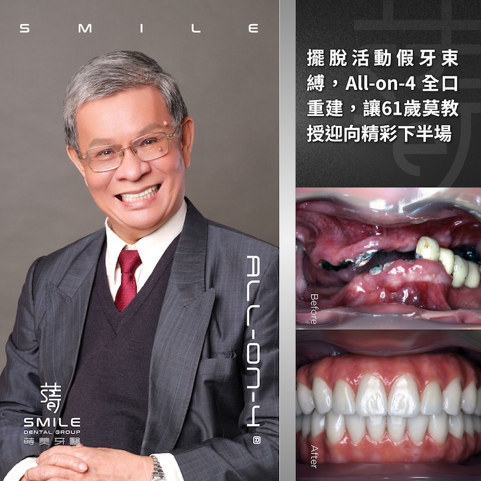擺脫活動假牙束縛，All-on-4 全口重建，讓61歲莫教授迎向精彩下半場