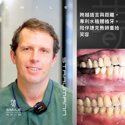 跨越語言與距離，專利水植體植牙，陪伴捷克教師重拾笑容-拷貝