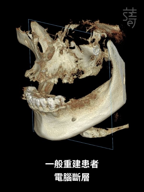 黃 All-on-5 顴骨植牙 一般重建患者 電腦斷層