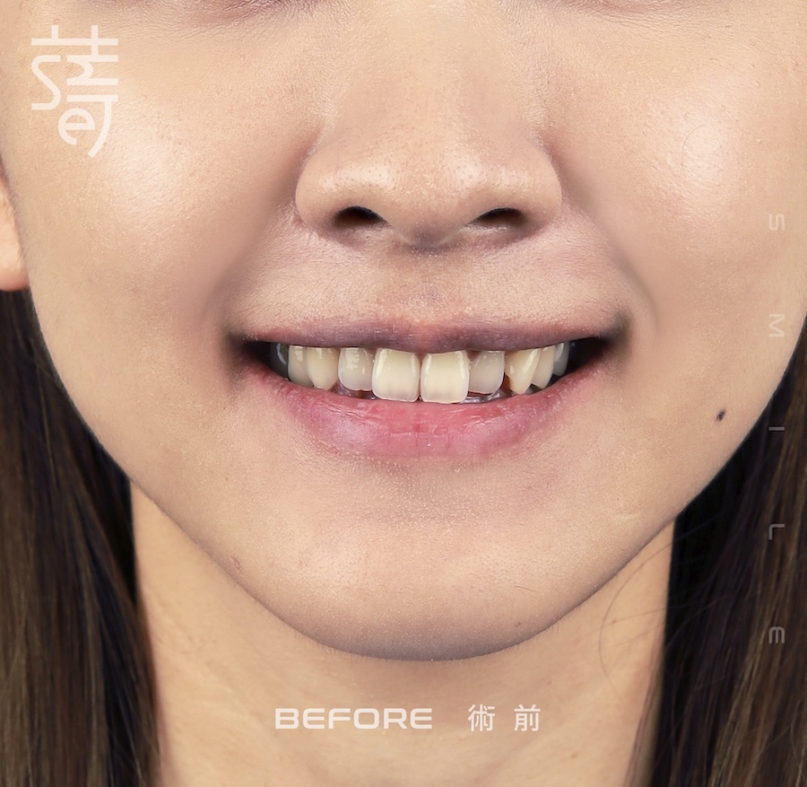 林玟誼 隱適美 柯醫師 女星林玟誼隱適美畢業3下半顏術前_MG_9982 拷貝