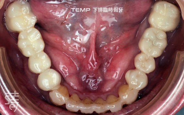 下排臨時假牙9433