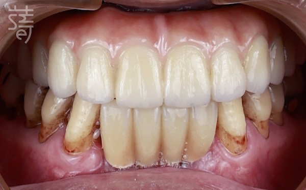 黃 All-on-5 顴骨植牙：讓「不可能植牙」的他 口內 口內術前術後-01
