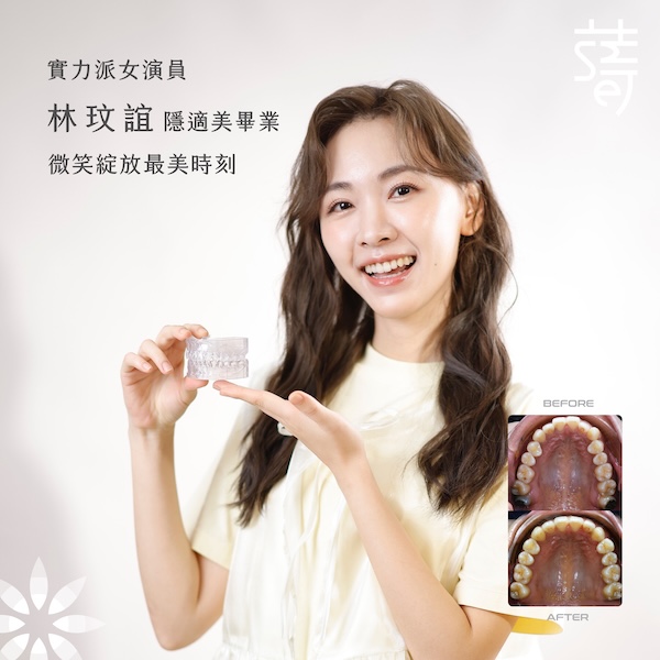 IMG_0499 實力派女演員林玟誼隱適美畢業，微笑綻放最美時刻-Acclaimed-Actress-Lin-Wen-Yi-Completes-Invisalign-—-Her-Most-Radiant-Smile-Yet封面