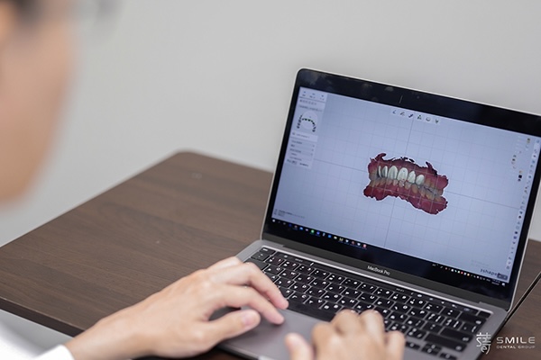 數位微笑設計DSD笑容蛻變之旅：DSD讓瓷牙貼片更自然