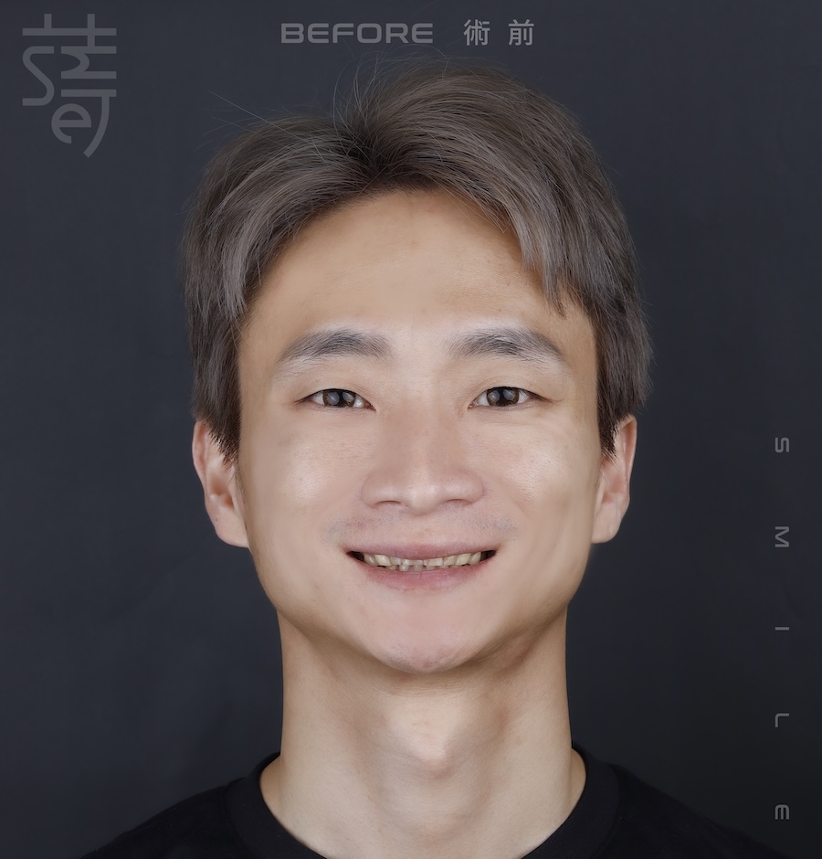 李 先生 蒔美 薛聖儒 磨牙術前_MG_7726