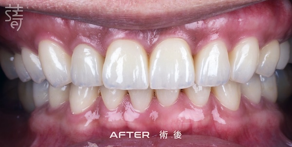 李 先生 蒔美 薛聖儒 磨牙術後 調整 IMG_7718 2