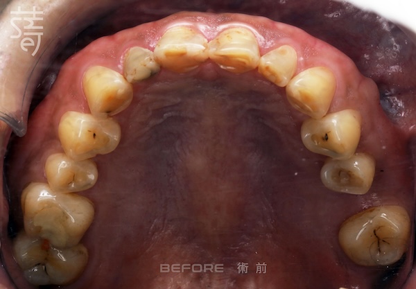 李 先生 蒔美 薛聖儒 磨牙2 上排矯正前