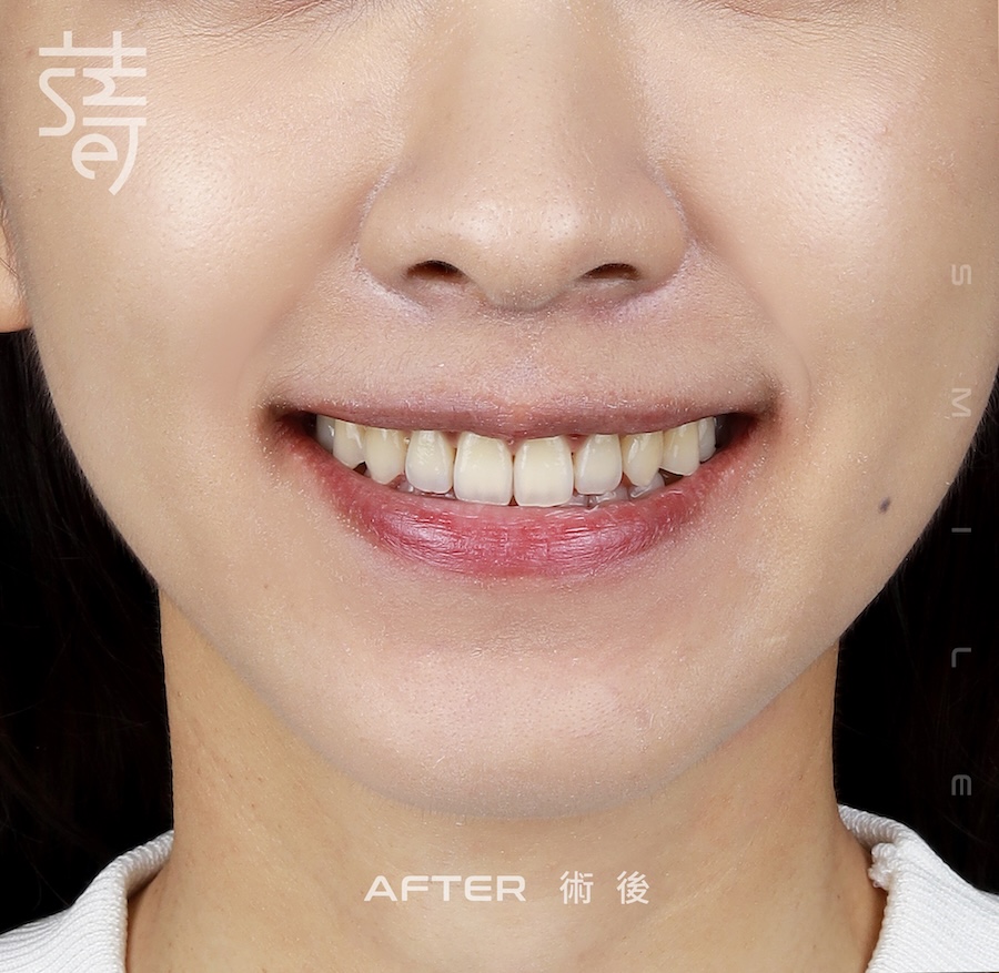 林玟誼 隱適美 柯醫師 下半顏術後 _MG_9982 拷貝2