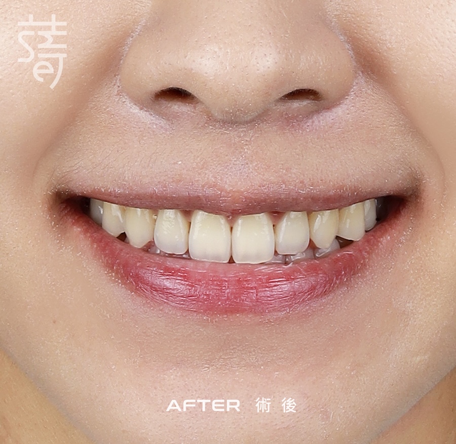 林玟誼 隱適美 柯醫師 特寫術後 _MG_9982