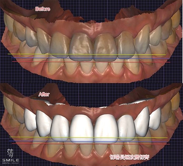 正面觀變化圖笑容蛻變之旅：DSD讓瓷牙貼片更自然