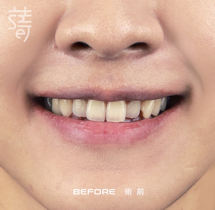 林玟誼 隱適美 柯醫師 特寫術前_MG_9982