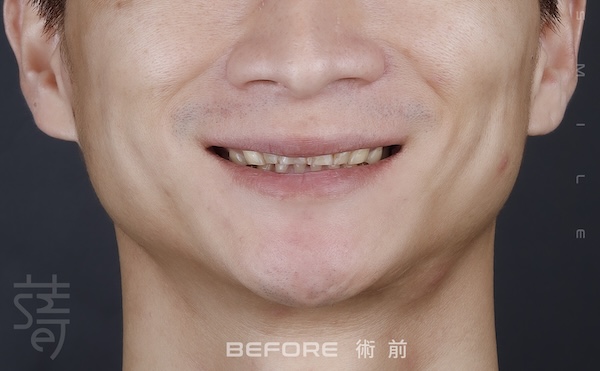 磨牙蒔美薛聖儒醫師全瓷笑容李術前 _MG_0431拷貝