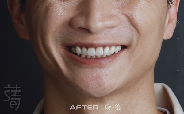 磨牙蒔美薛聖儒醫師全瓷笑容李術後_拷貝