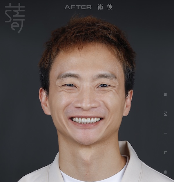 磨牙蒔美薛聖儒醫師全瓷笑容李1110術後拷貝2