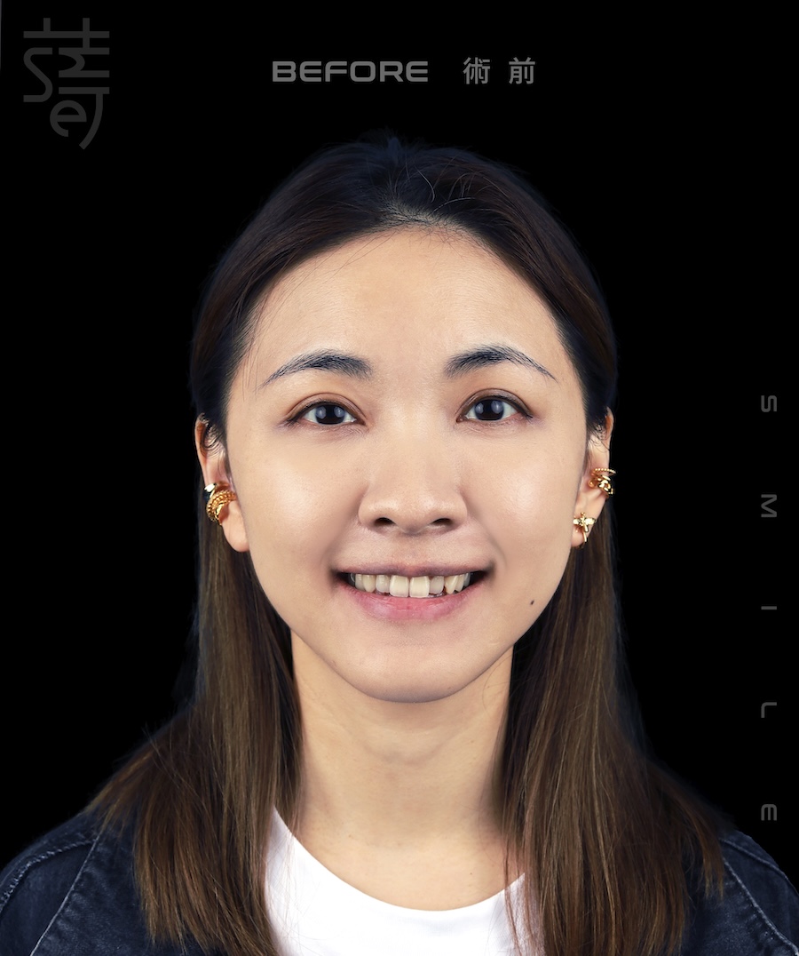 林玟誼 隱適美 柯醫師 術前 _MG_9982 拷貝