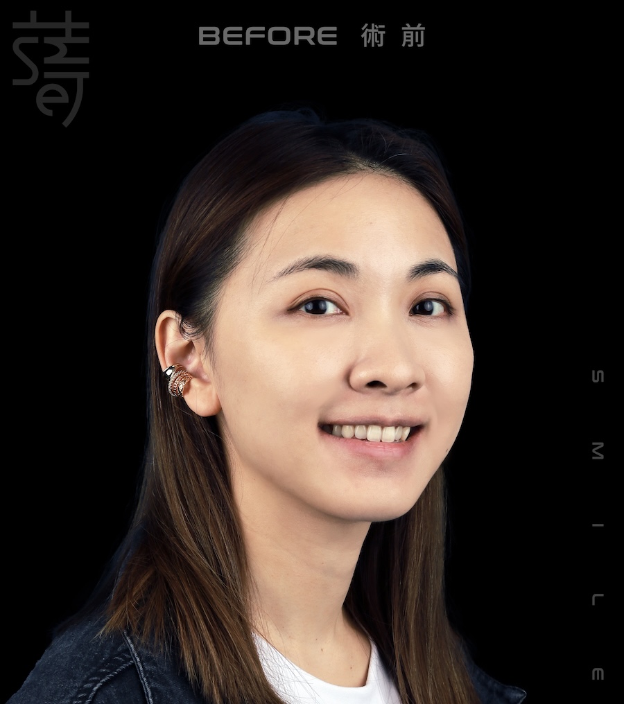 林玟誼 隱適美 柯醫師 女星林玟誼隱適美畢業3術前_MG_9988 拷貝 2