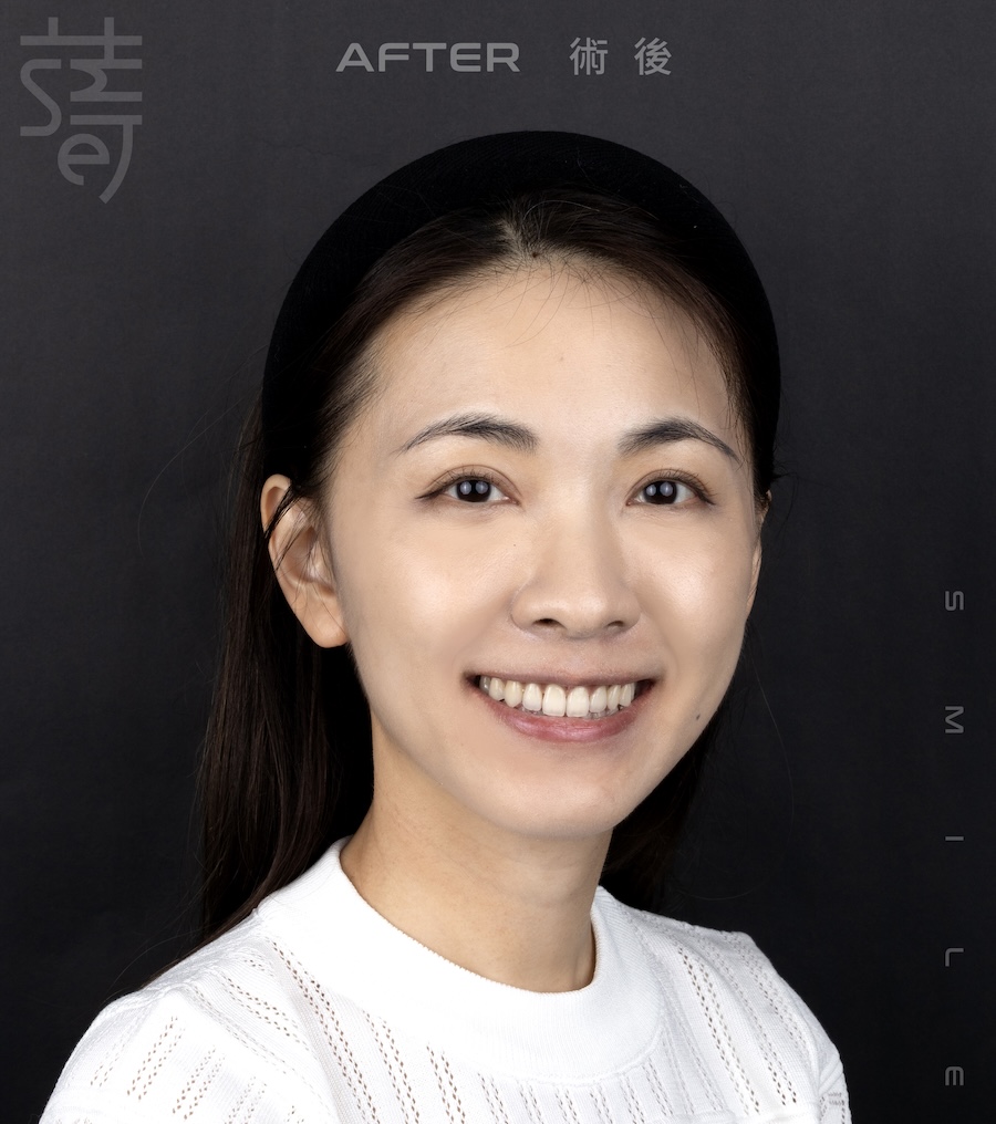 林玟誼 隱適美 柯醫師 女星林玟誼隱適美畢業3術後 _MG_9988 拷貝