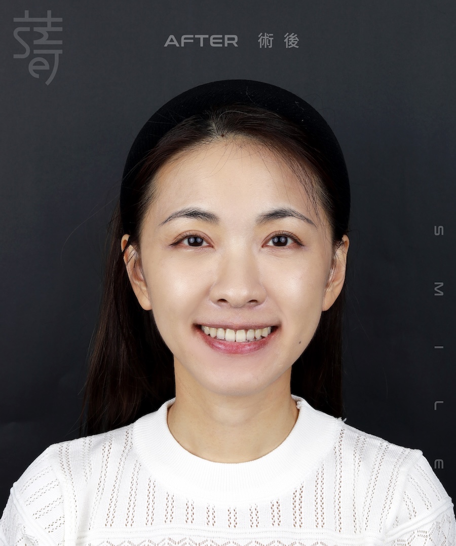 林玟誼 隱適美 柯醫師 術後_MG_9982 拷貝