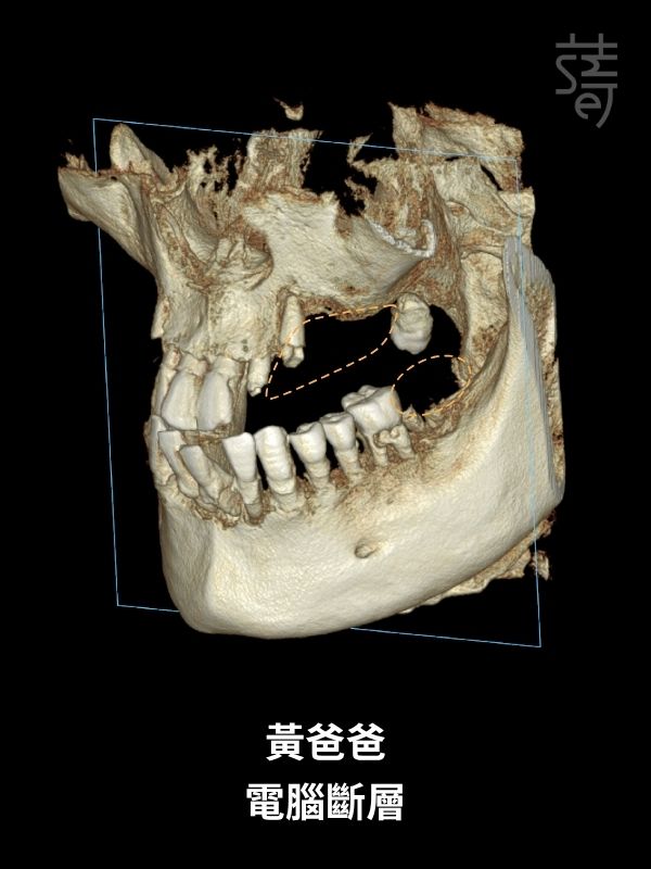 黃 All-on-5 顴骨植牙 黃爸爸 電腦斷層
