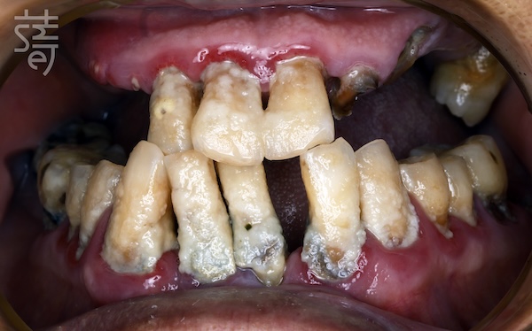 黃 All-on-5 顴骨植牙：讓「不可能植牙」的他 口內正與側術前-02
