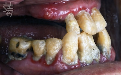 黃 All-on-5 顴骨植牙：讓「不可能植牙」的他 口內正與側術前-03