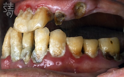 黃 All-on-5 顴骨植牙：讓「不可能植牙」的他 口內正與側術前-04