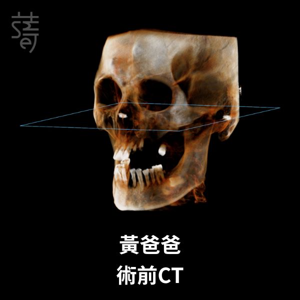 黃 All-on-5 顴骨植牙：讓「不可能植牙」的他 黃爸爸術前CT