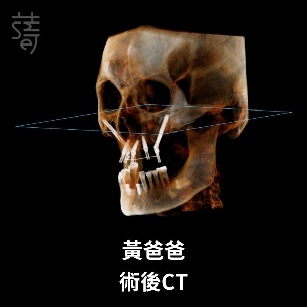 黃 All-on-5 顴骨植牙：讓「不可能植牙」的他 黃爸爸術後CT