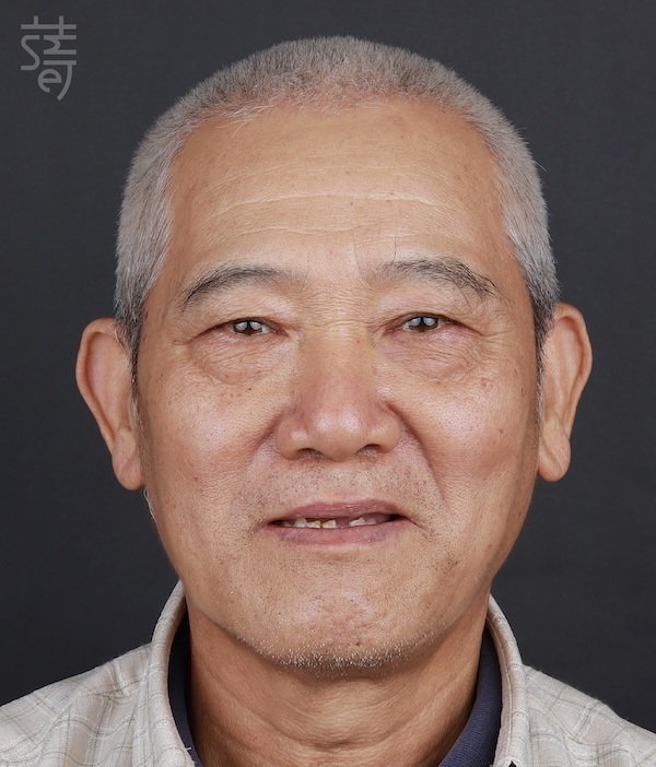 2黃明清 術前術後