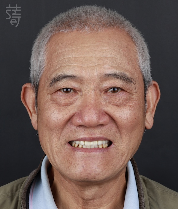 2黃明清 術前術後