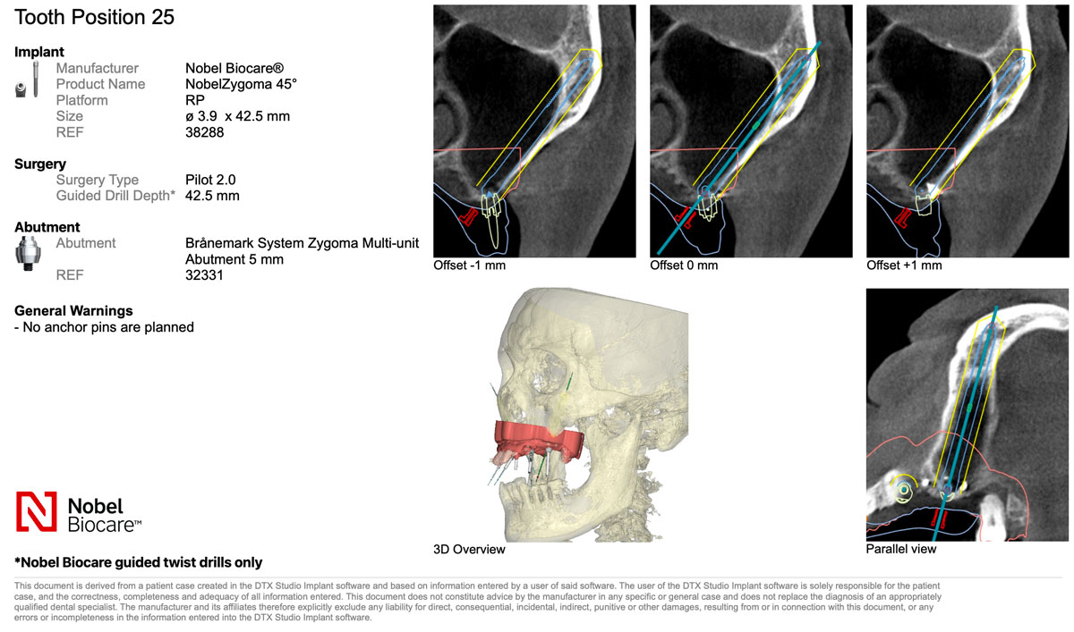 黃 All-on-5 顴骨植牙 黃_Zygomatic