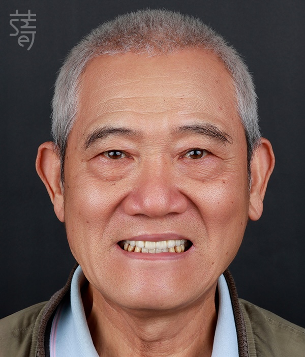 黃after正臉_MG_0608All-on-5-顴骨植牙:讓「不可能植牙」的他