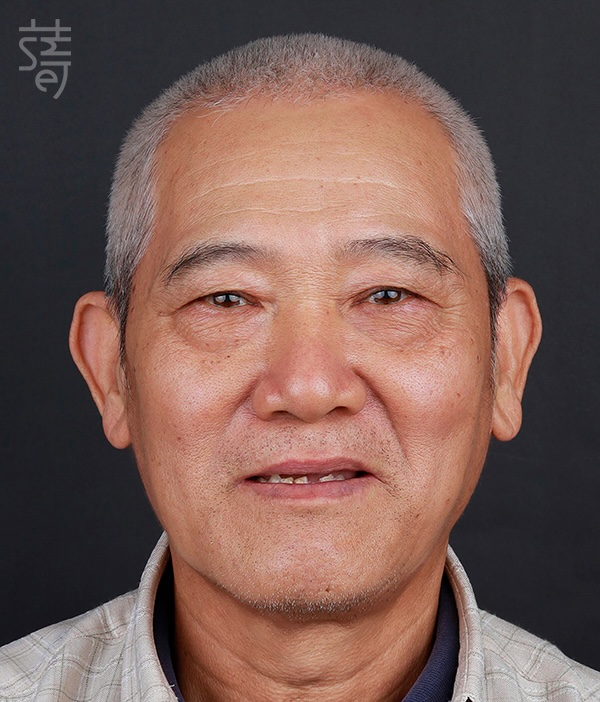 黃before正臉_MG_9925All-on-5-顴骨植牙:讓「不可能植牙」的他