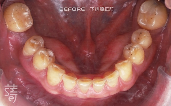 1下排矯正前 7721
