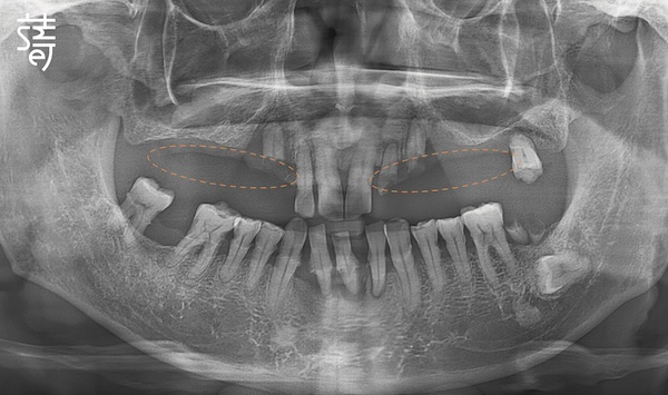 黃 All-on-5 顴骨植牙 術前術後X光
